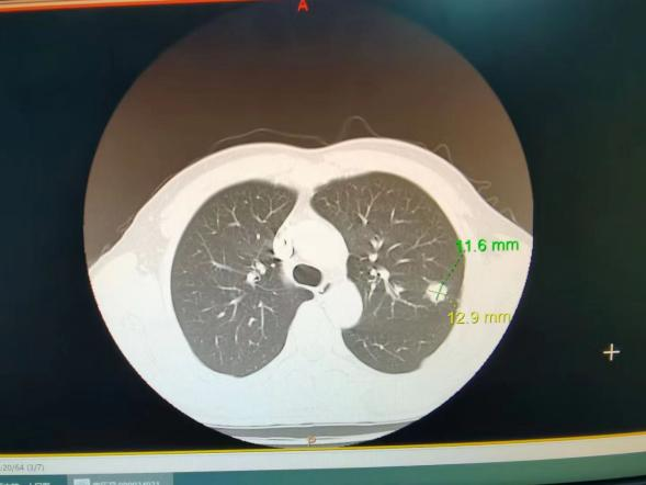 九江市第一人民医院生命活水医疗集团呼吸一科开展ct引导下肺癌微波